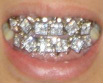 Tooth Grill Picture